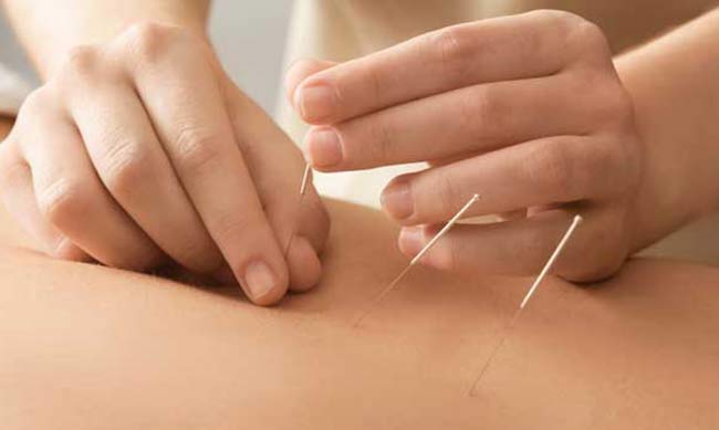 Trigger Point Dry needling Patient